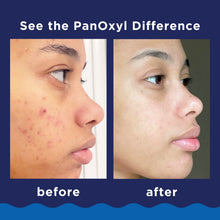 PanOxyl-Foaming-Acne-Wash-10-Ben4_e95cd8d7-bd7e-4297-a48f-9d0b2f336d7b - USA Mega Market